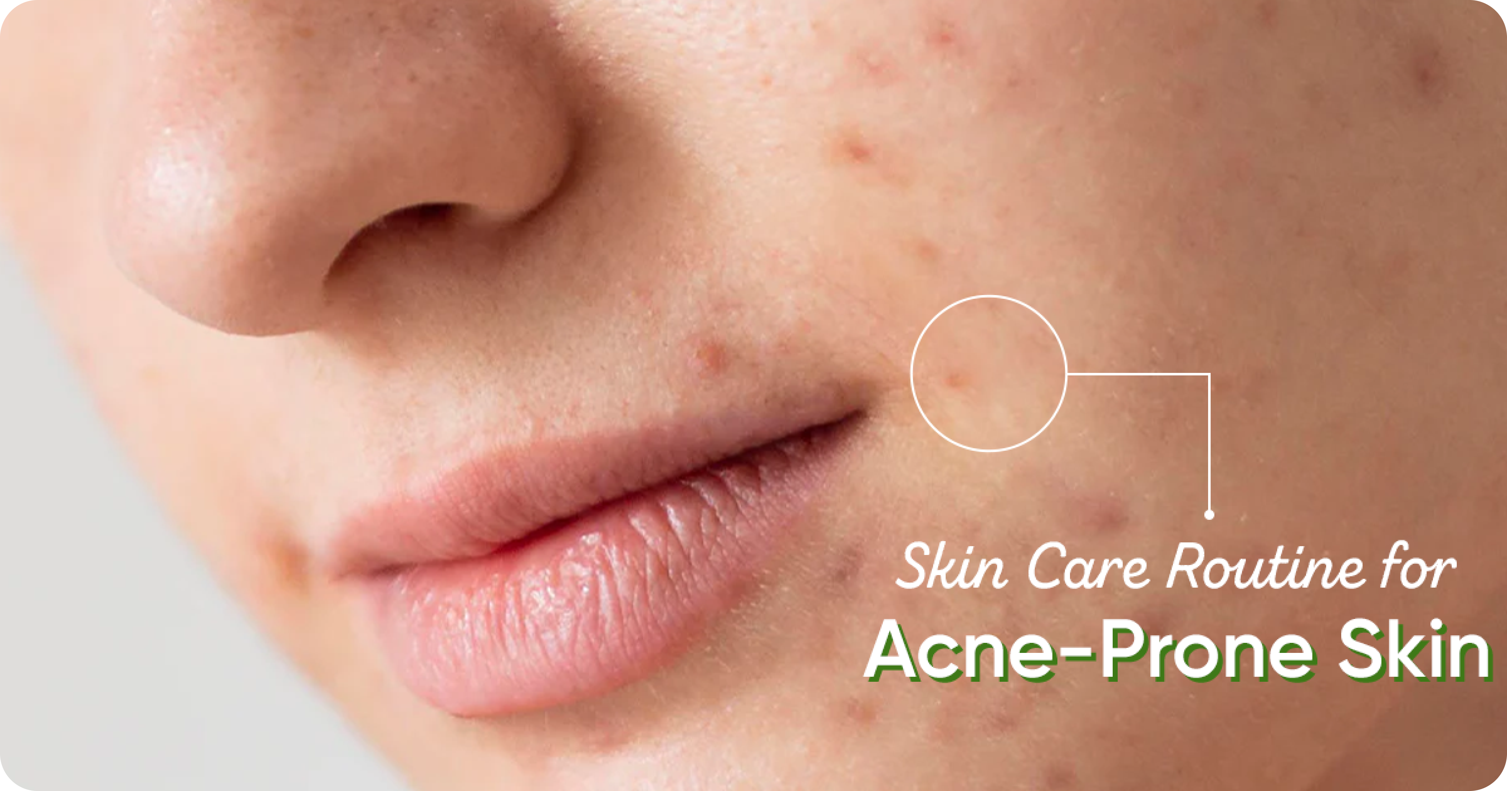 Best Skin Care Routine for Acne-Prone Skin (AM & PM)