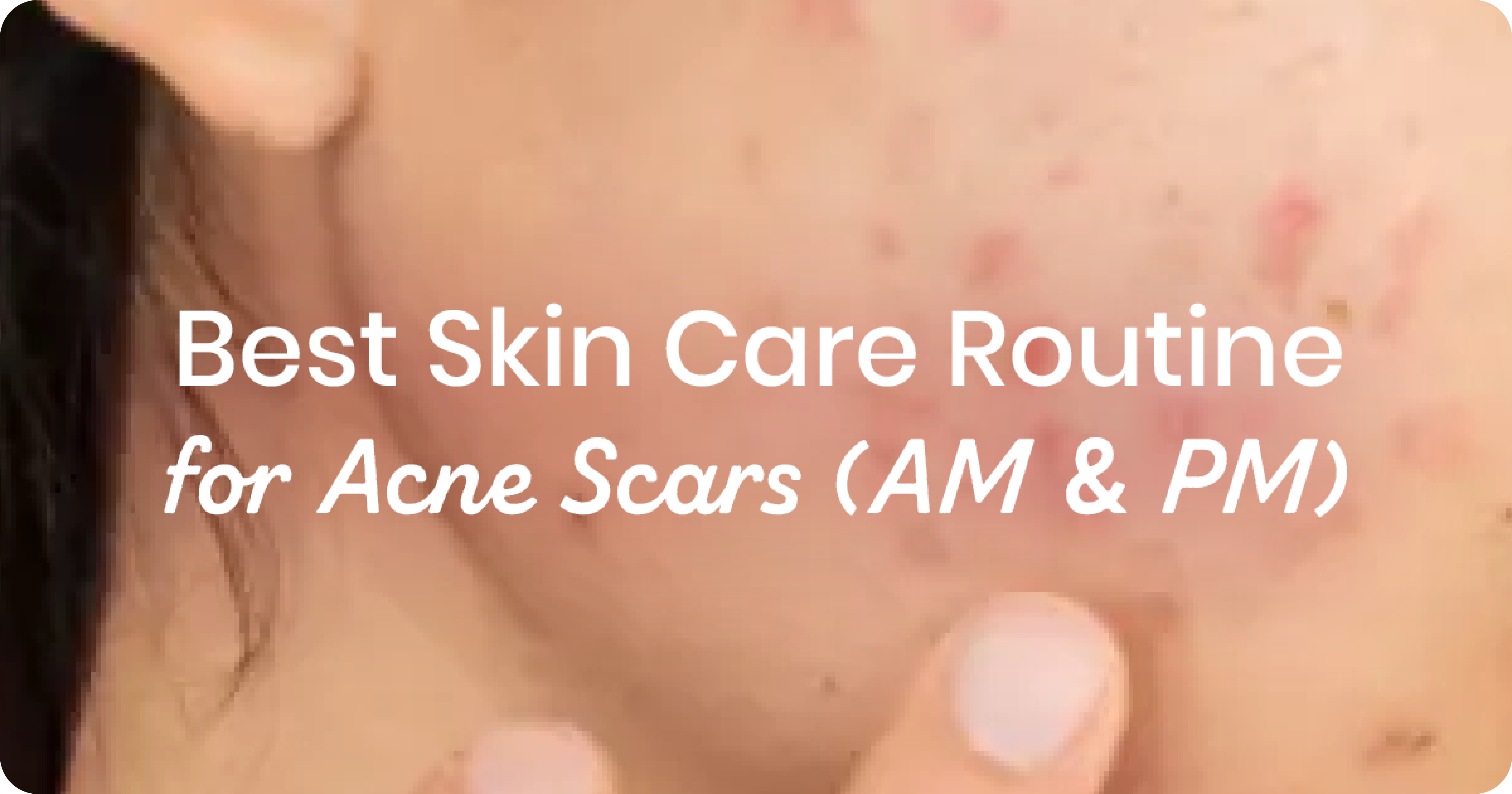 Best Skin Care Routine for Acne Scars (AM & PM)